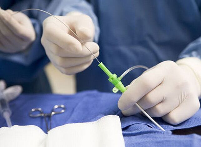 Radiofrekvenční ablace